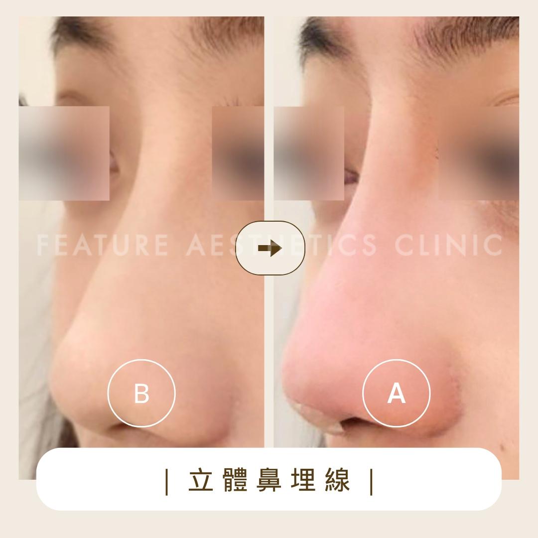 鼻部側面處理位置示意 10｜馥之美診所療程紀錄