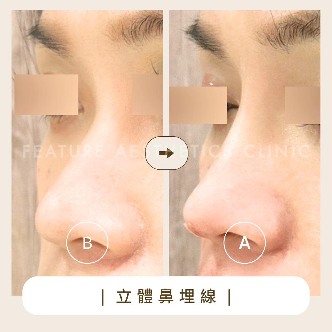鼻部側面處理位置示意 9｜馥之美診所療程紀錄