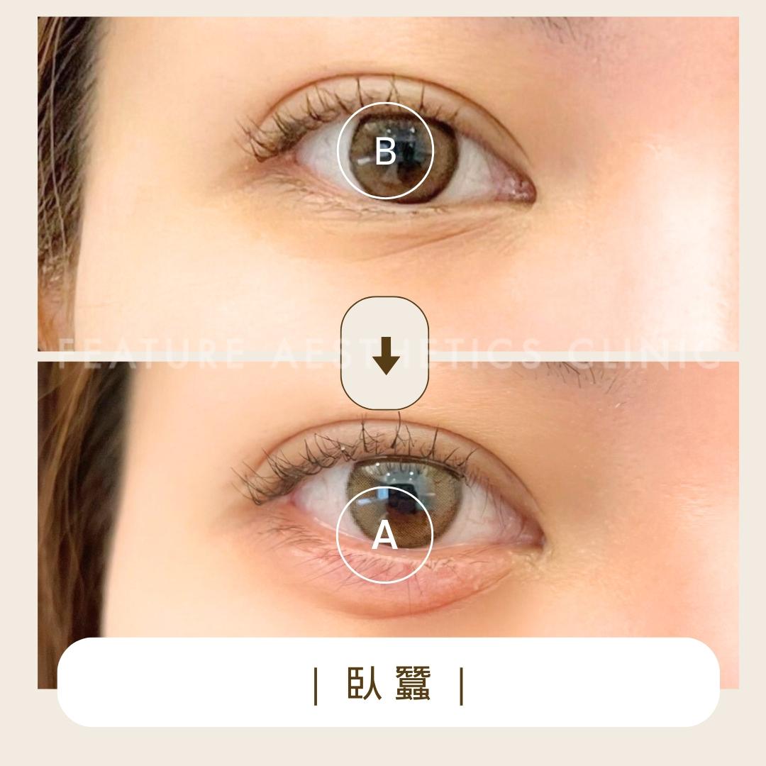 眼下臥蠶位置示意 8|馥之美診所療程紀錄