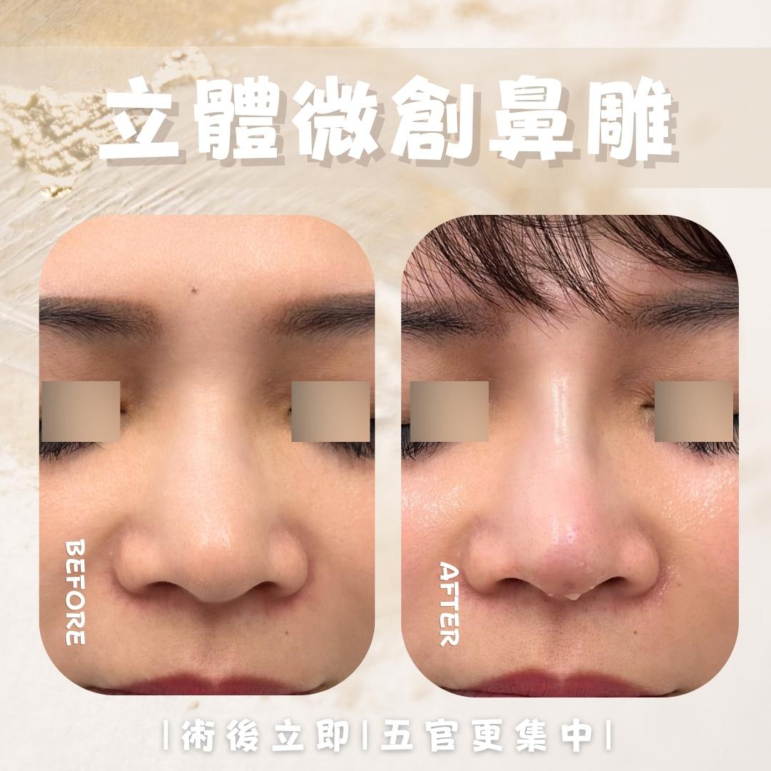 鼻部側面處理位置示意 8｜馥之美診所療程紀錄
