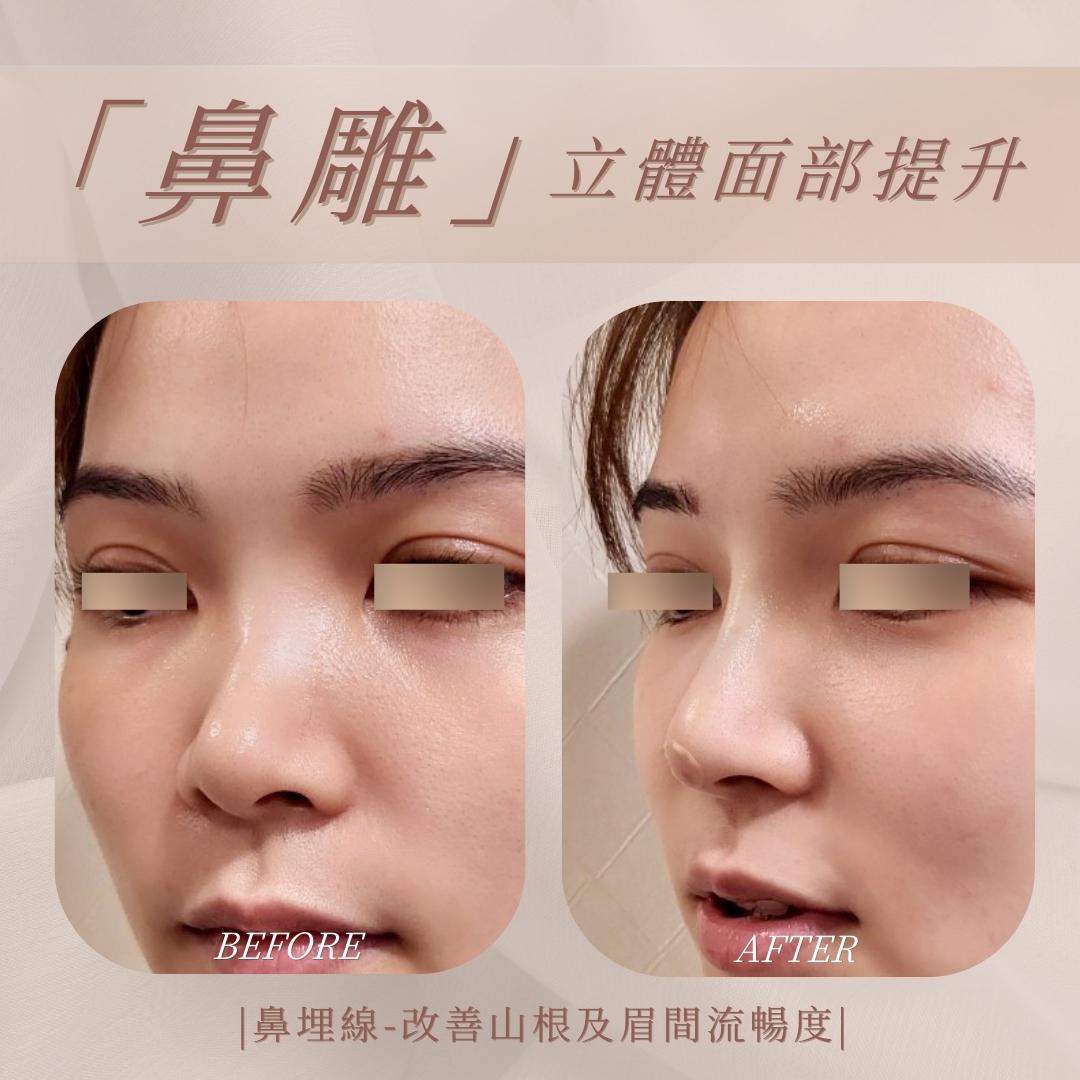 鼻部側面處理位置示意 5｜馥之美診所療程紀錄