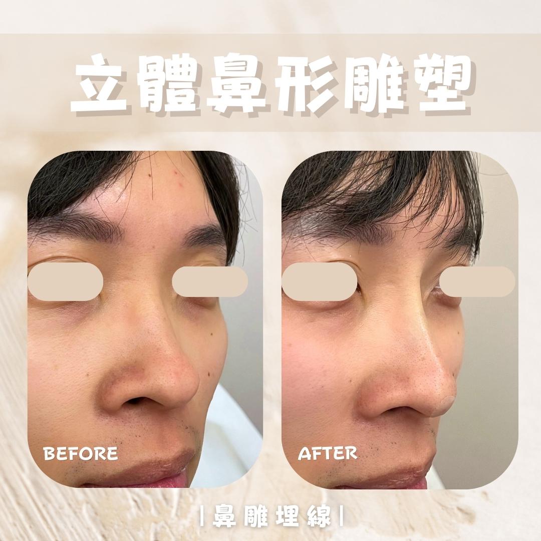 鼻部側面處理位置示意 4｜馥之美診所療程紀錄