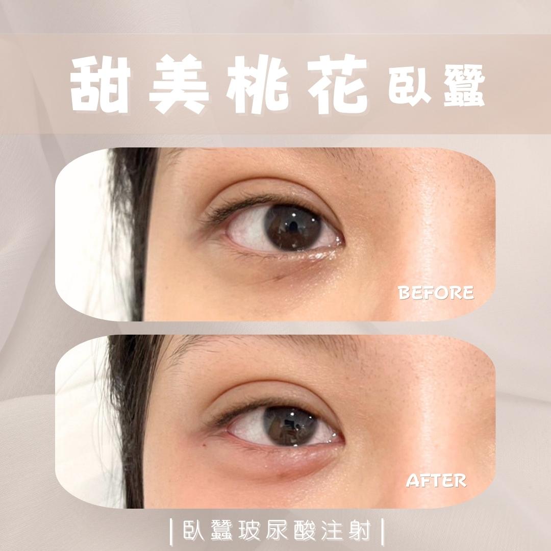 眼下臥蠶位置示意 4|馥之美診所療程紀錄