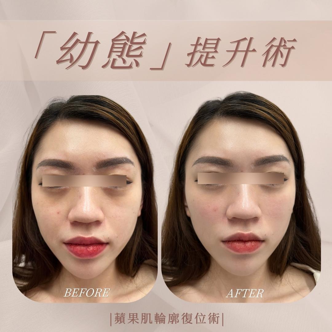 幼態提升術-蘋果肌輪廓-處理位置示意|馥之美診所療程紀錄