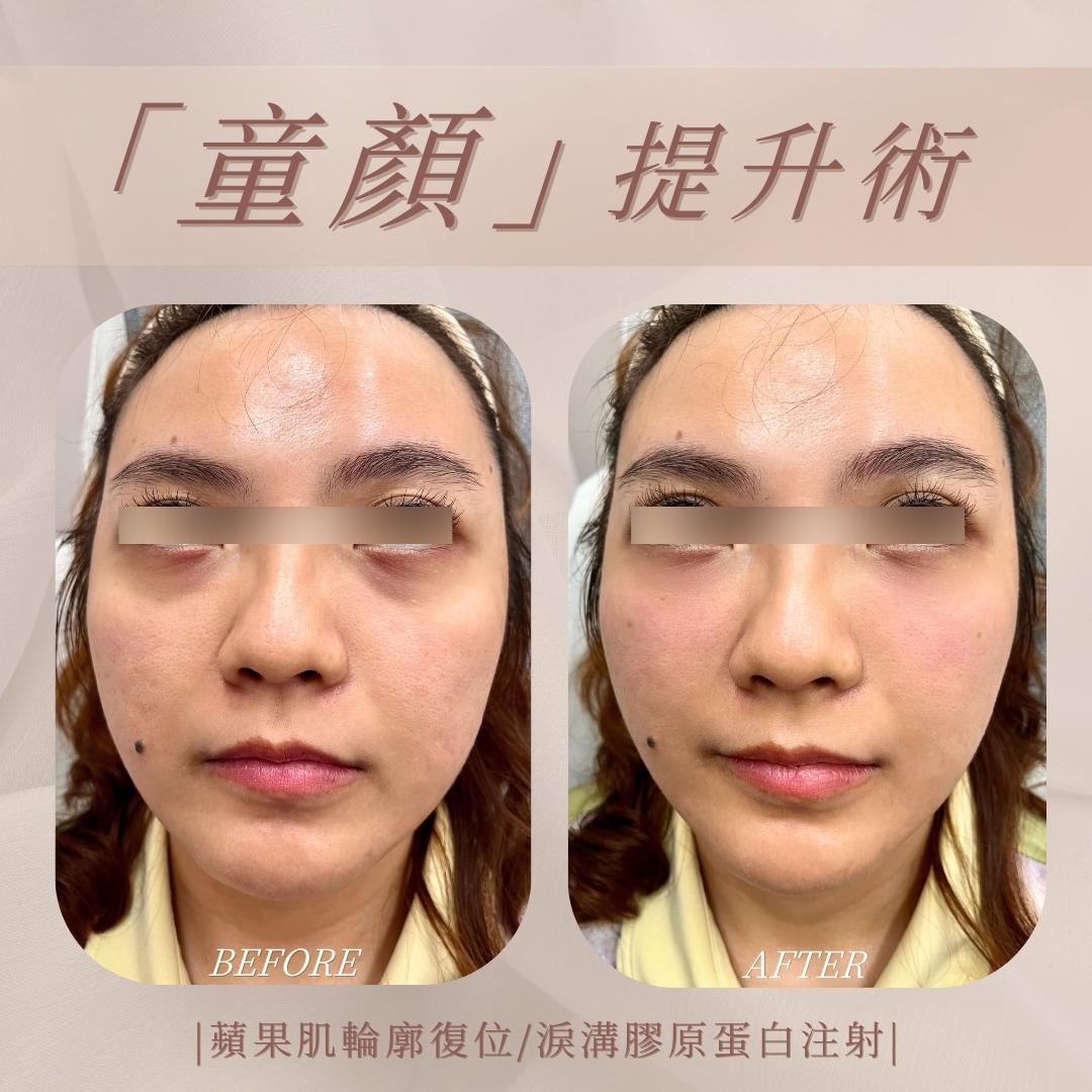 幼態提升術-中臉支撐結構-處理層次示意|馥之美診所療程紀錄