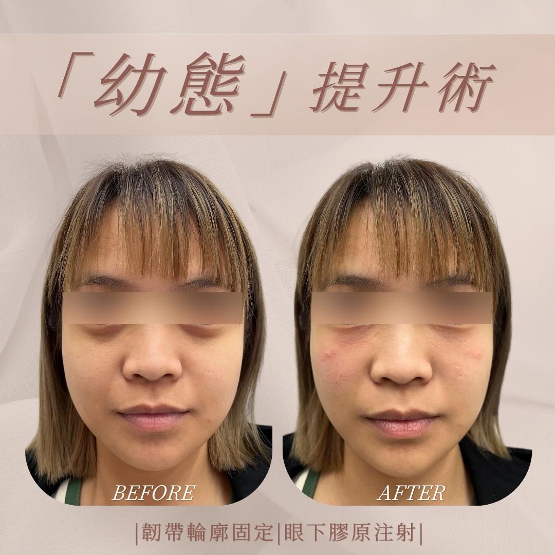 幼態提升術-韌帶輪廓固定與眼下注射-處理層次示意|馥之美診所療程紀錄