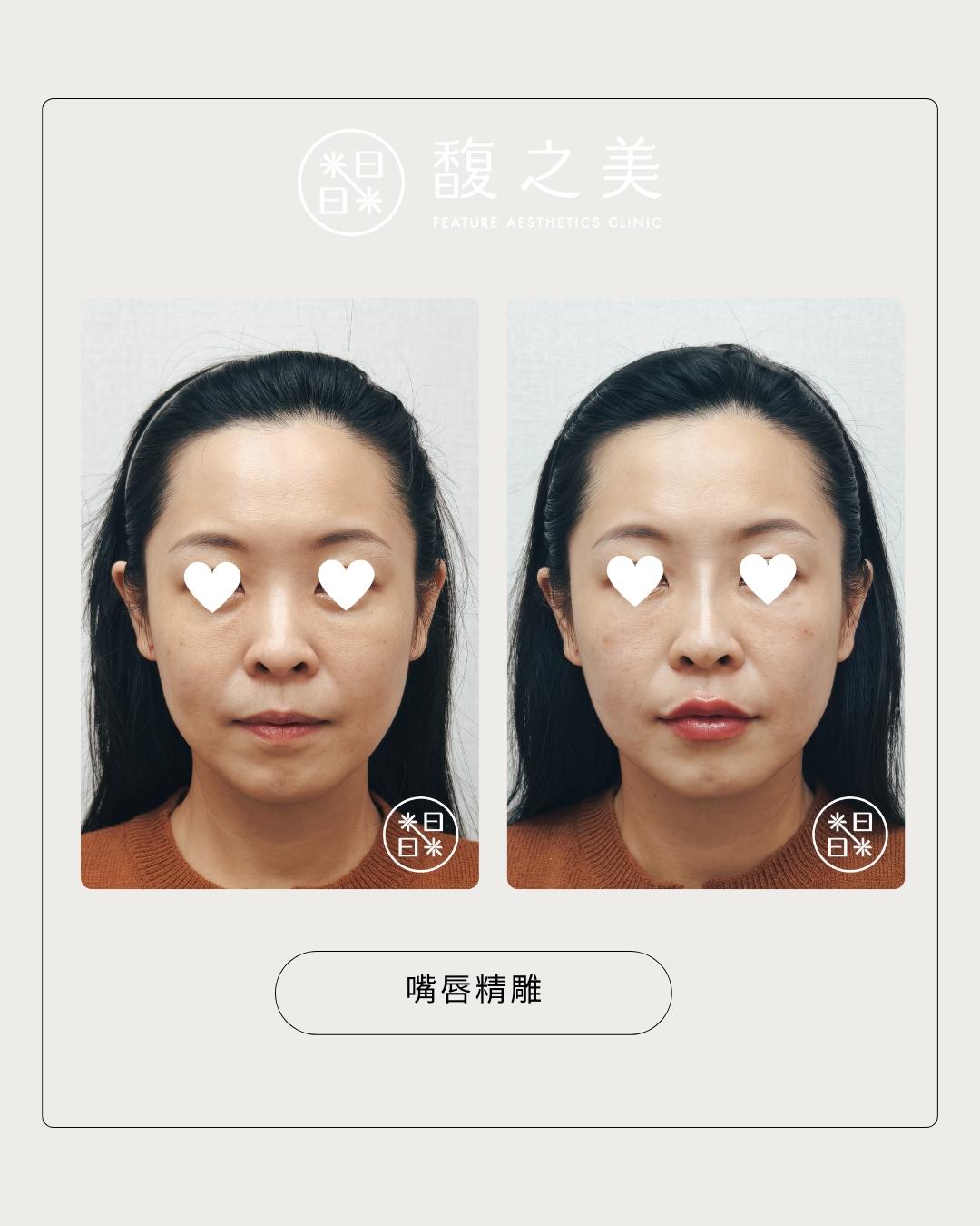 玻尿酸填補是什麼？作用部位、適應情況、禁忌症與風險說明