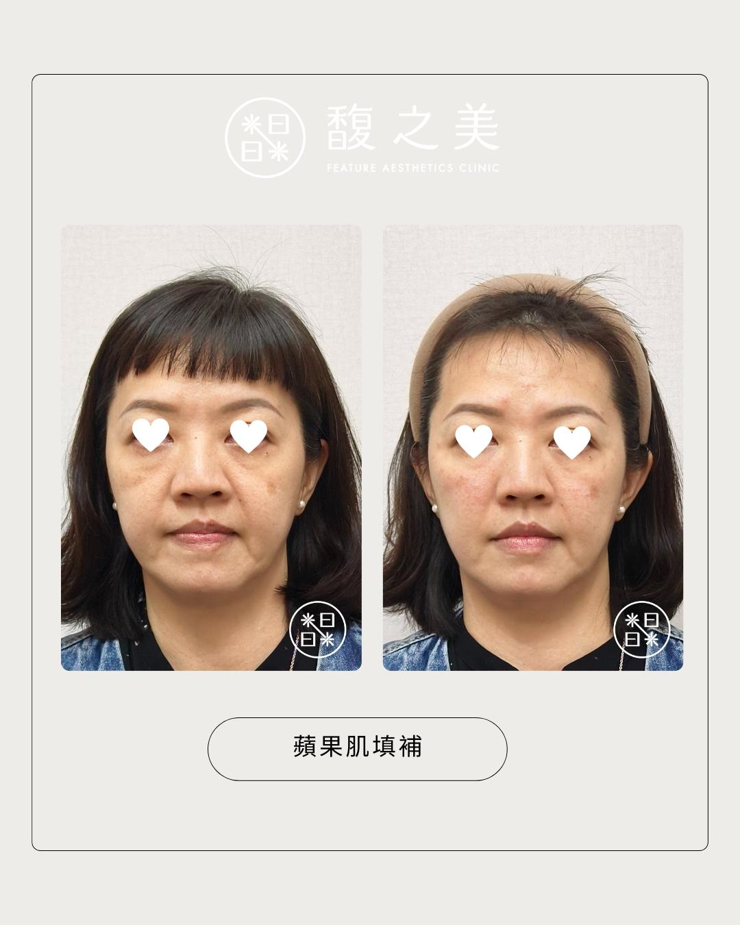 幼態提升術-中臉區域-處理位置示意|馥之美診所療程紀錄