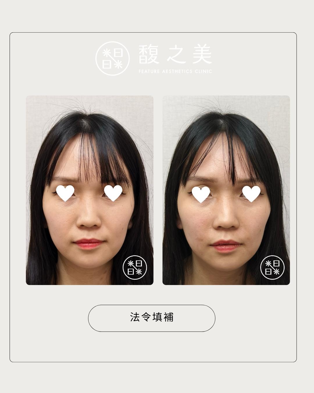 幼態提升術-中臉區域-處理位置示意|馥之美診所療程紀錄