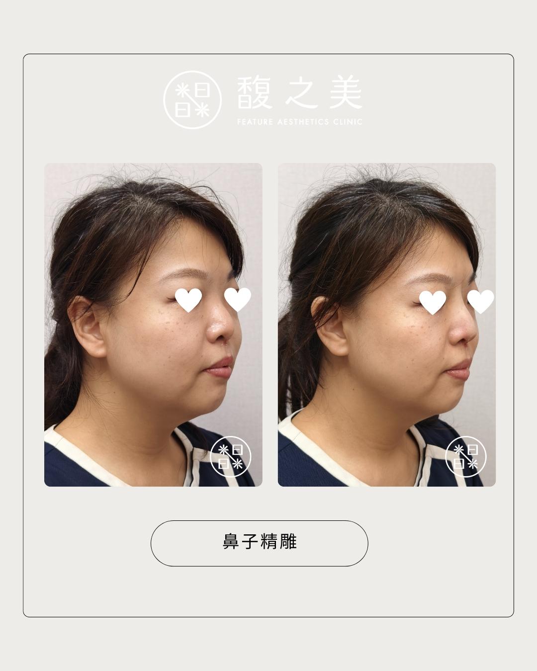 鼻部側面處理位置示意 1｜馥之美診所療程紀錄