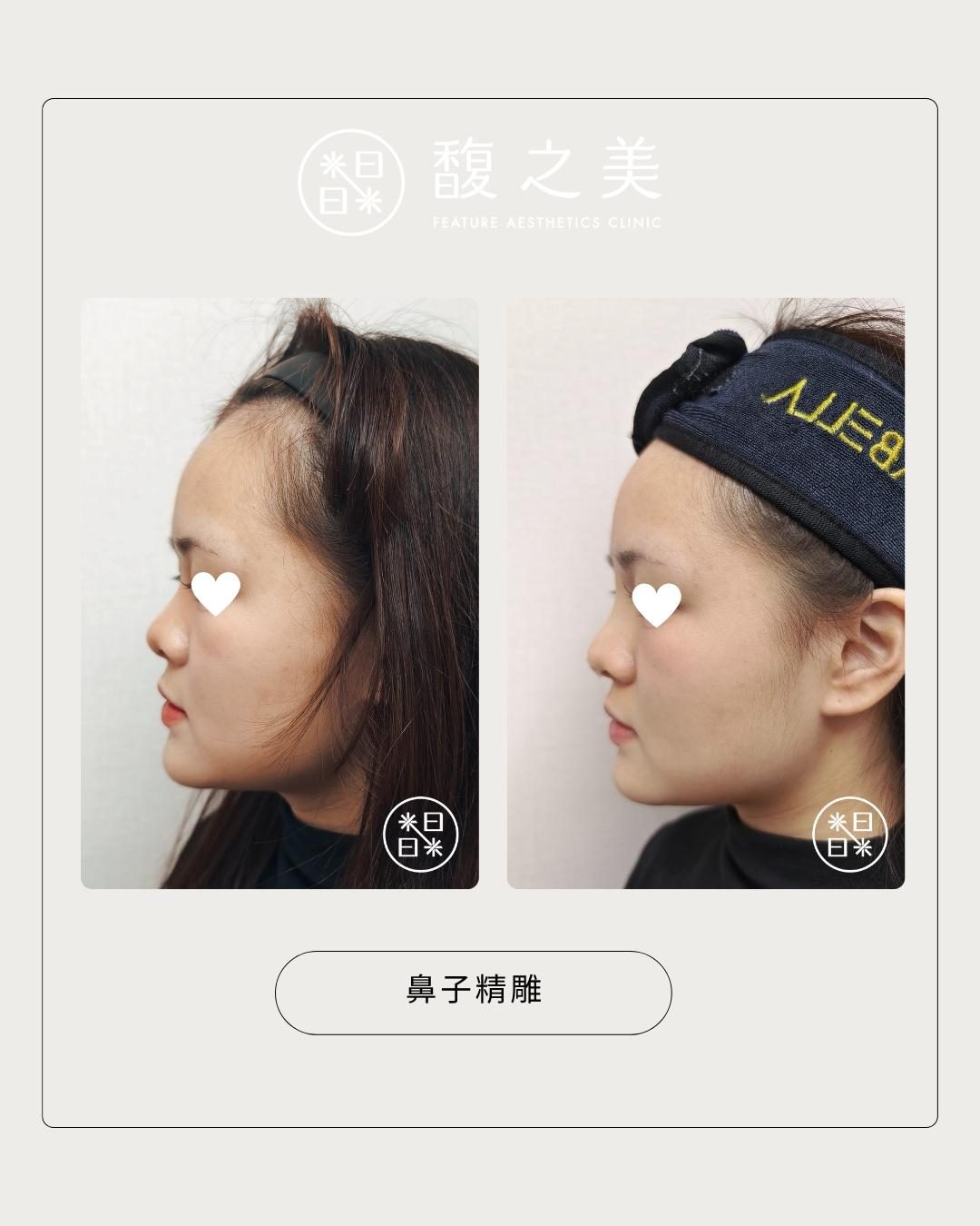 鼻部側面處理位置示意 2｜馥之美診所療程紀錄