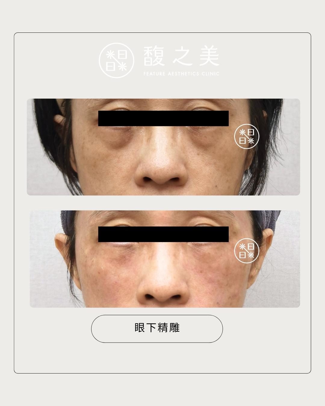 眼下區域處理位置示意 8|馥之美診所療程紀錄
