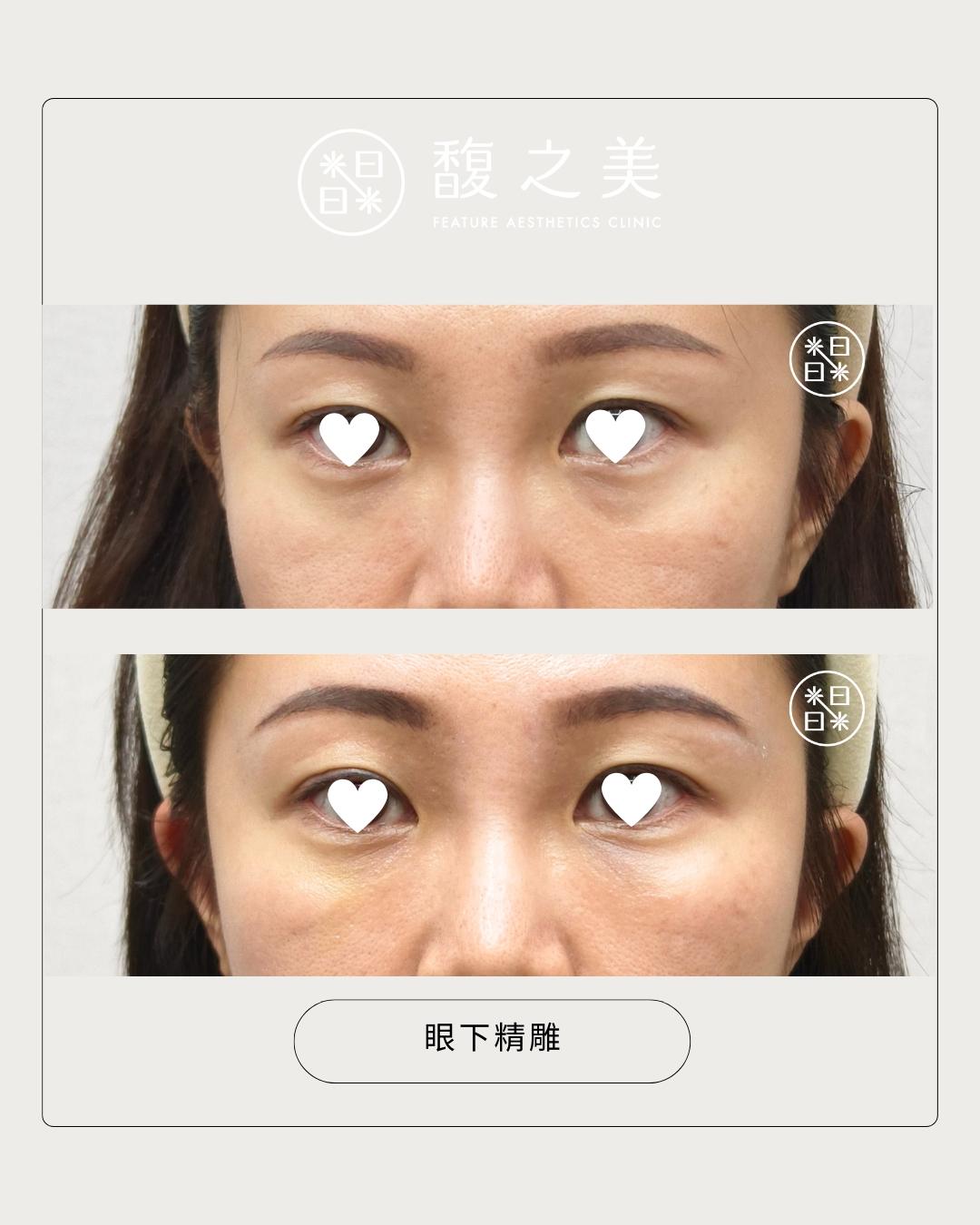 眼下區域處理位置示意 3|馥之美診所療程紀錄