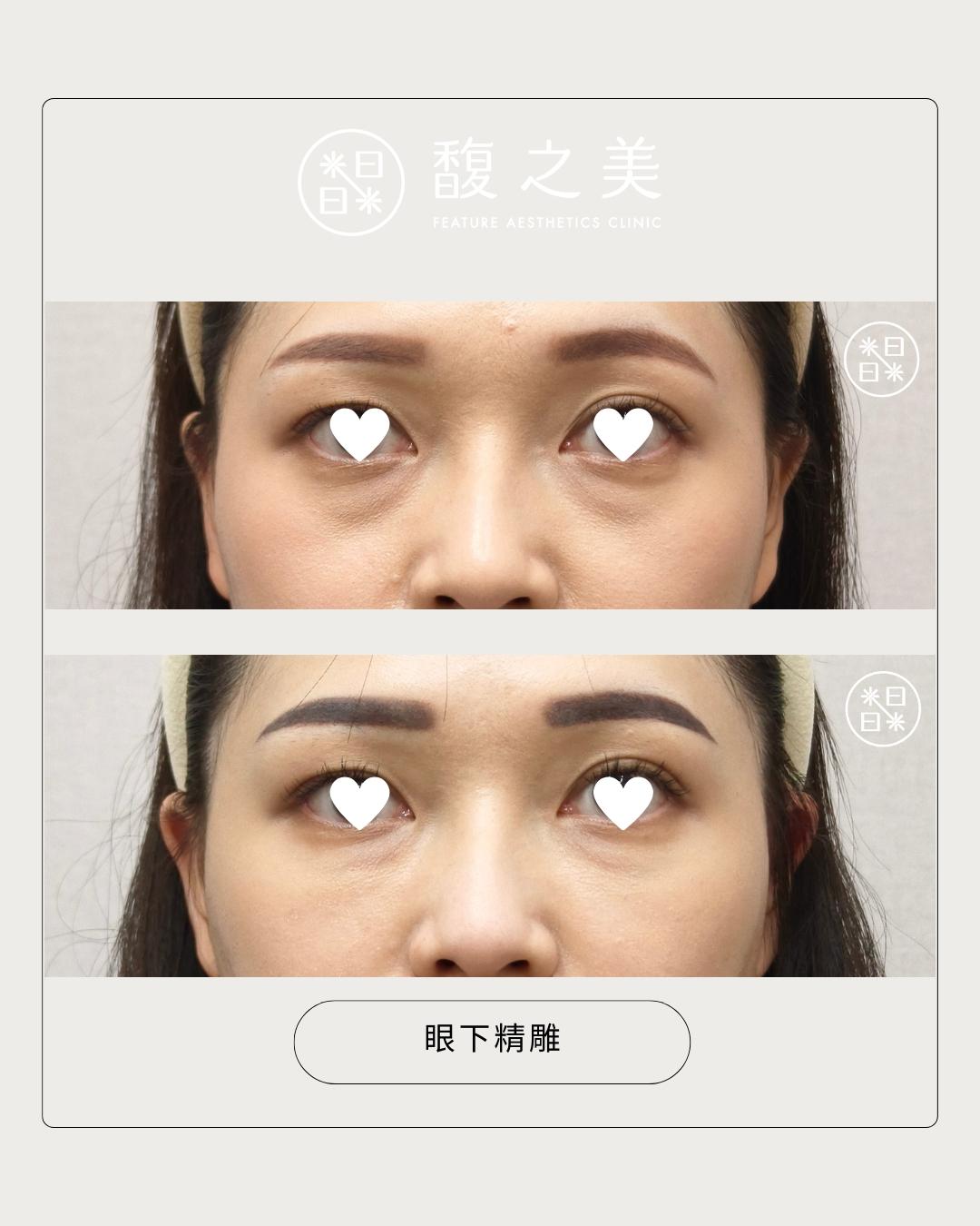 眼下區域處理位置示意 2|馥之美診所療程紀錄