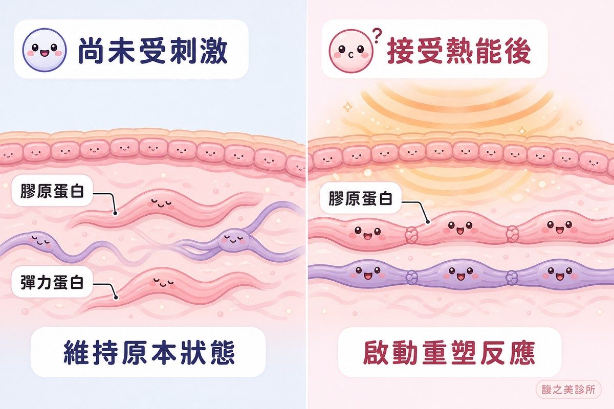 射頻熱效應刺激皮膚組織重塑的作用原理