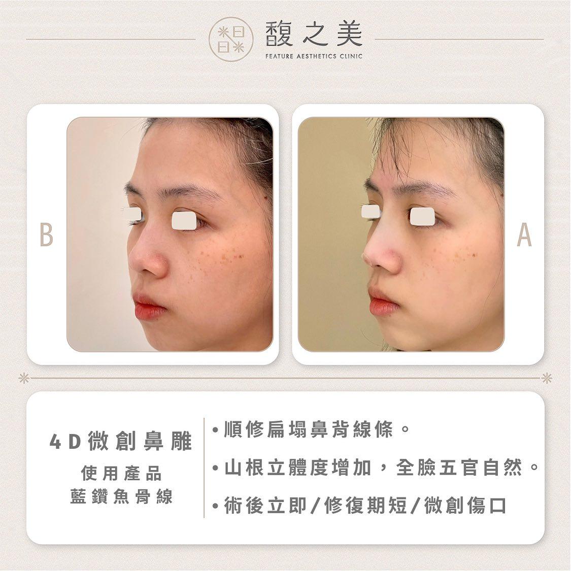 立體鼻線埋 - 馥之美診所美麗見證