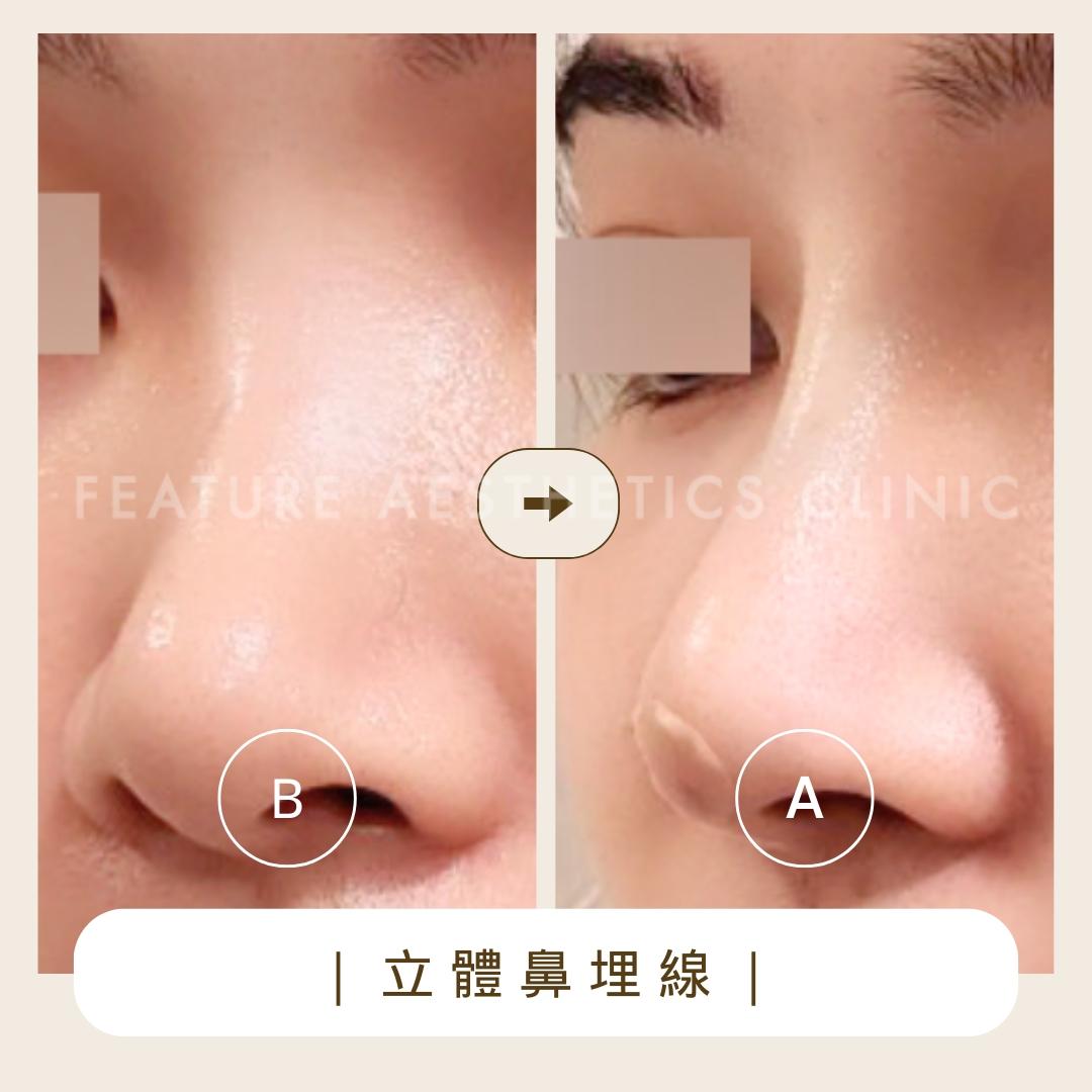 立體鼻線埋 - 馥之美診所美麗見證