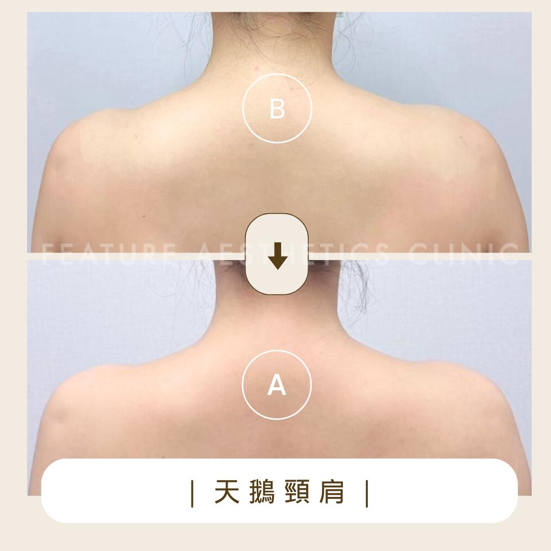 天鵝頸肩 - 馥之美診所美麗見證