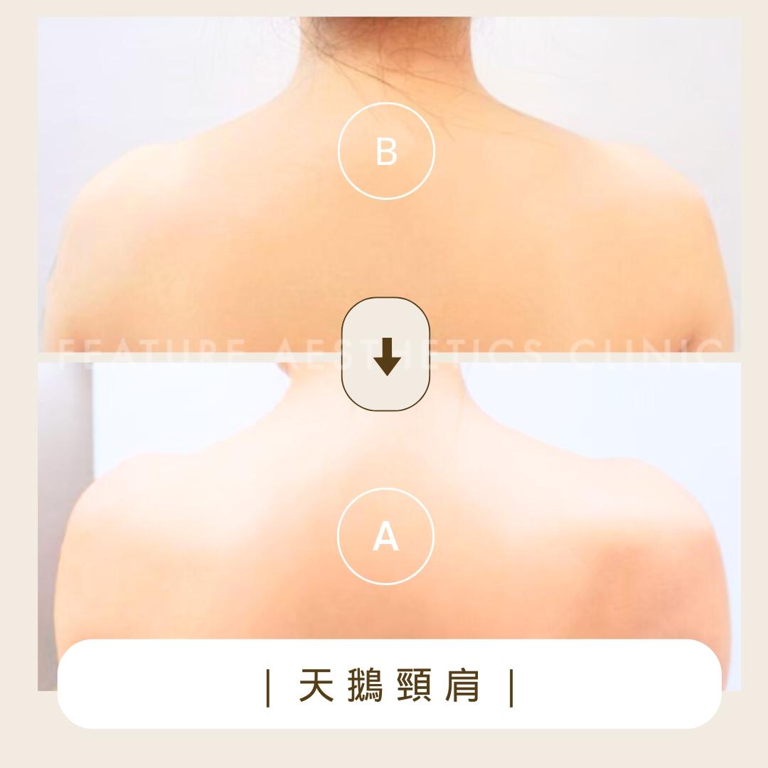 天鵝頸肩 - 馥之美診所美麗見證