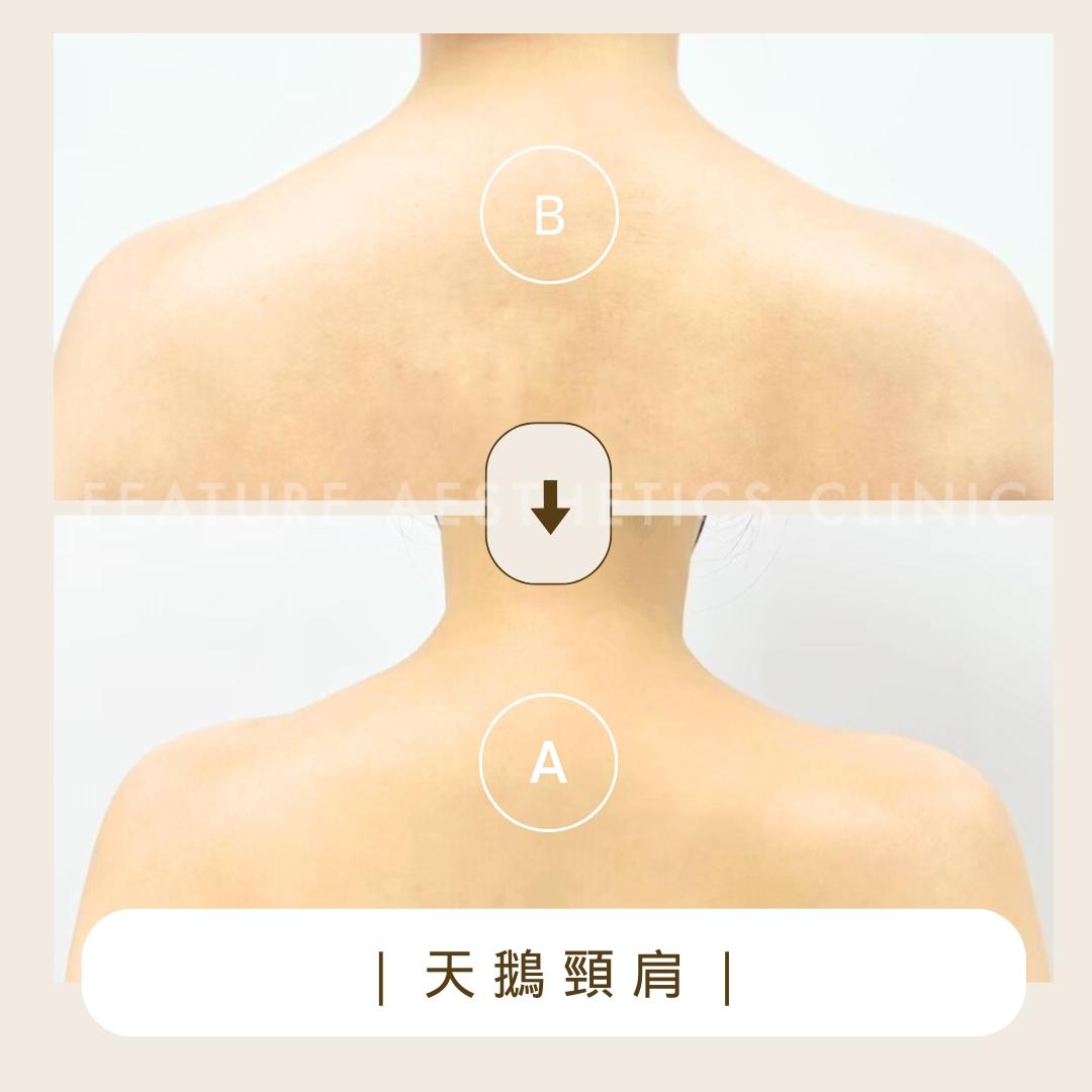 天鵝頸肩 - 馥之美診所美麗見證
