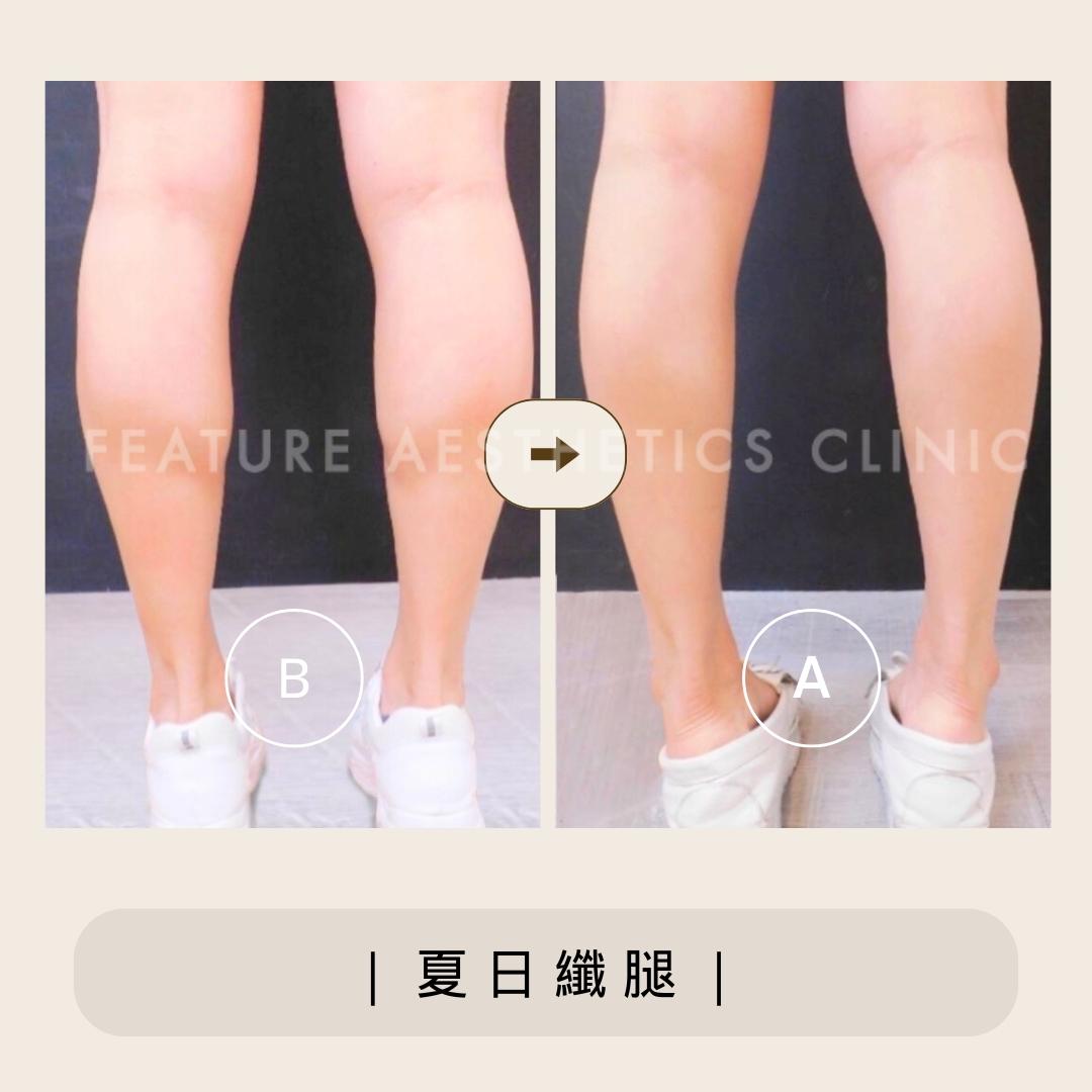 夏日纖腿 - 馥之美診所美麗見證