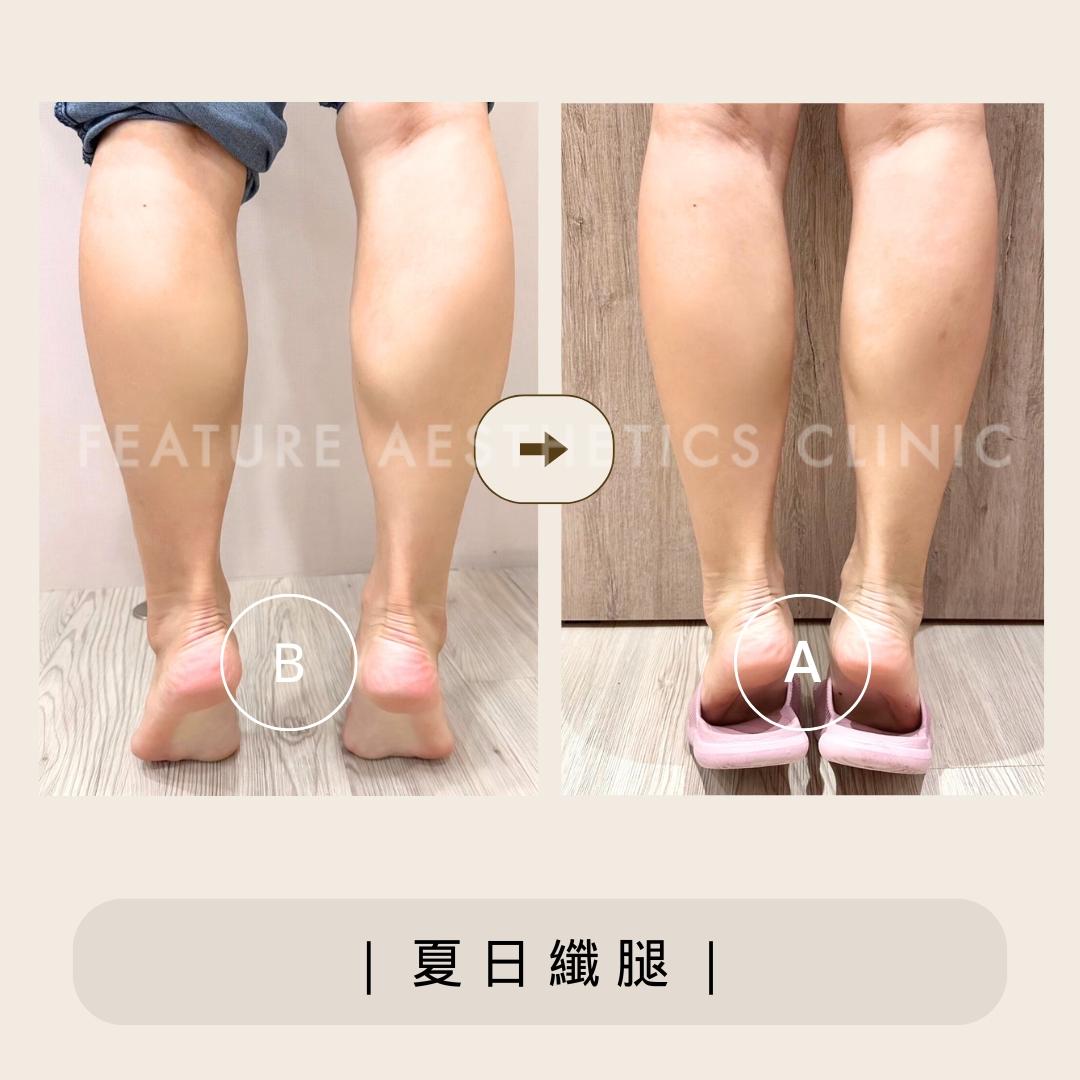 夏日纖腿 - 馥之美診所美麗見證