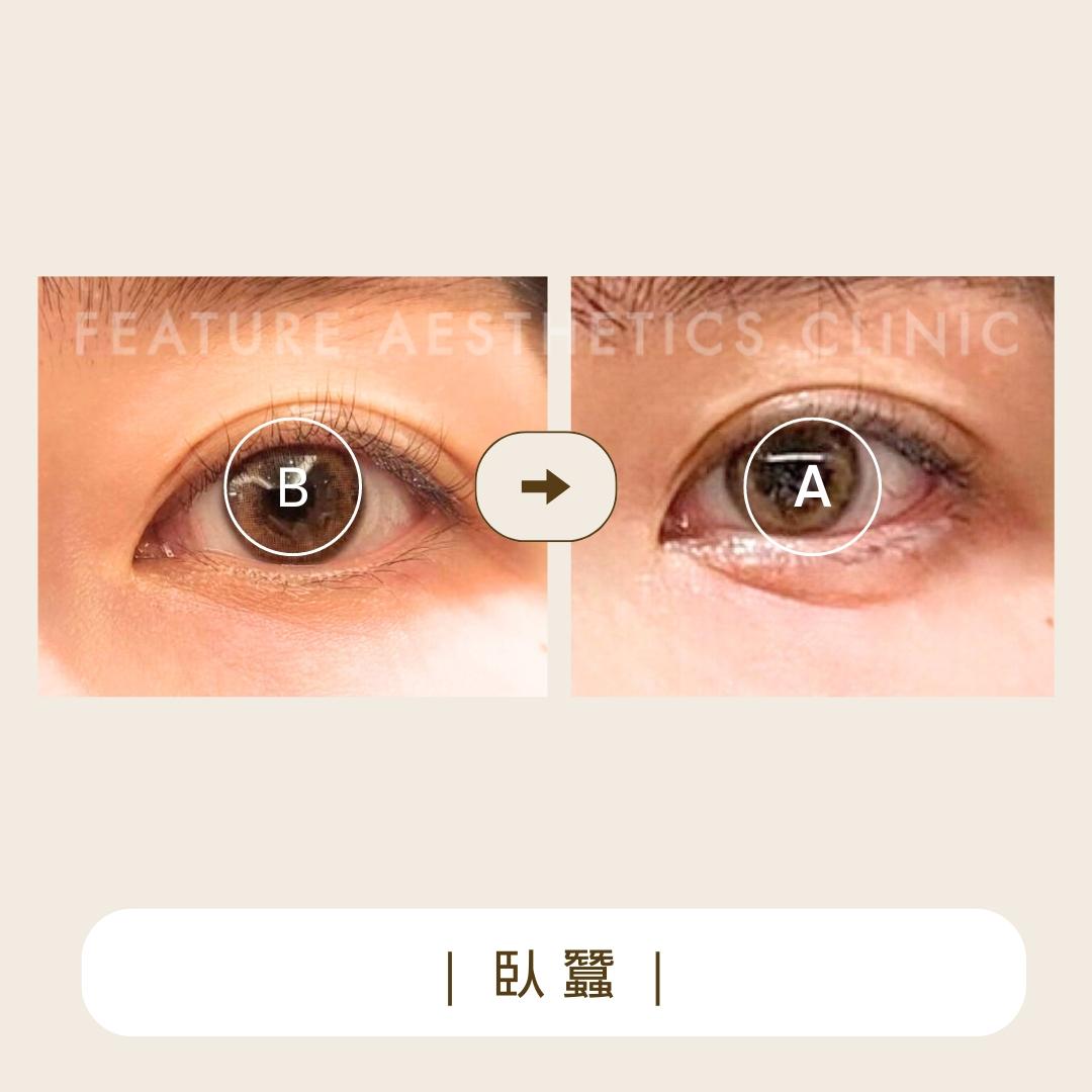 臥蠶 - 馥之美診所美麗見證