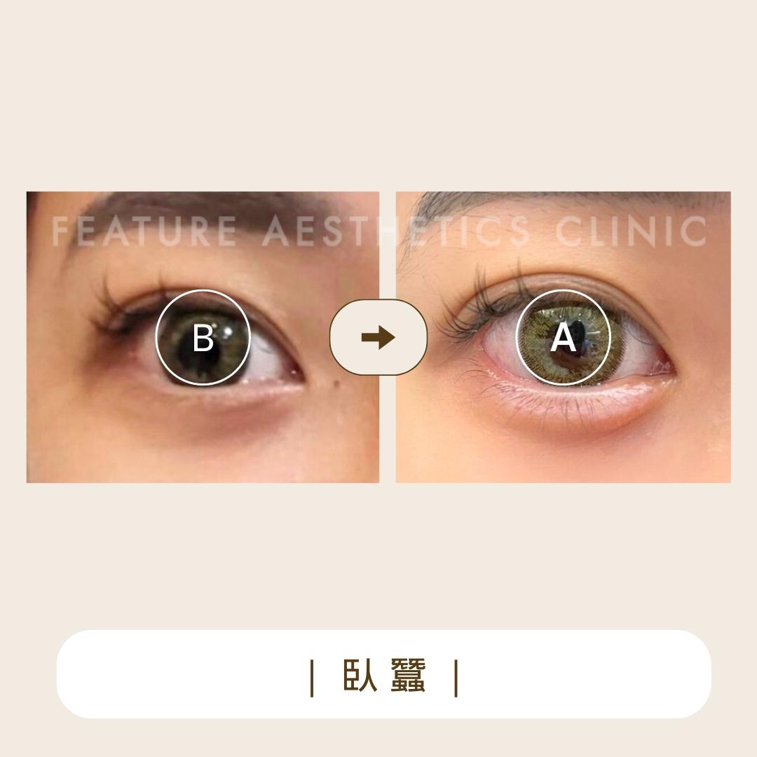 臥蠶 - 馥之美診所美麗見證
