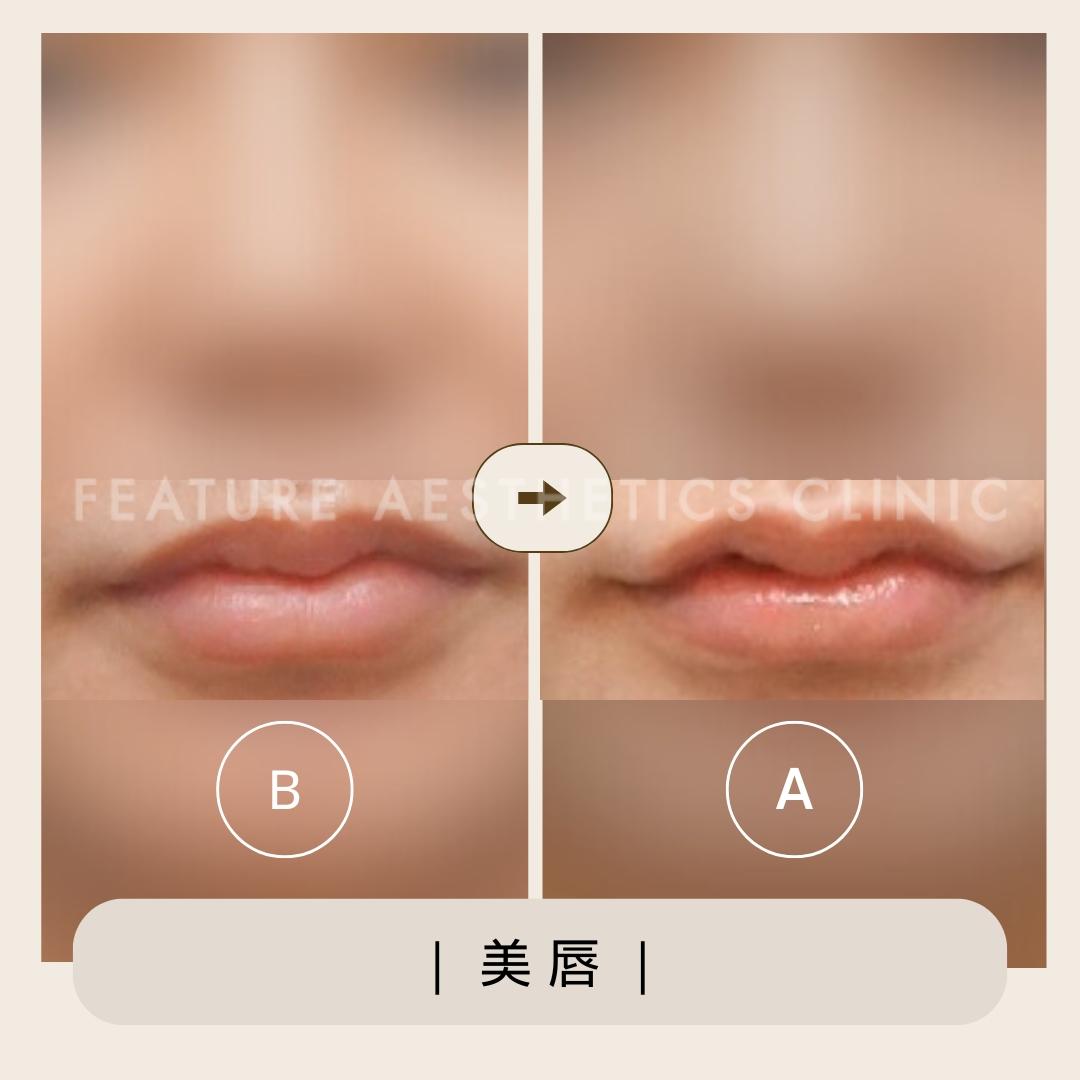 玻尿酸 - 馥之美診所美麗見證