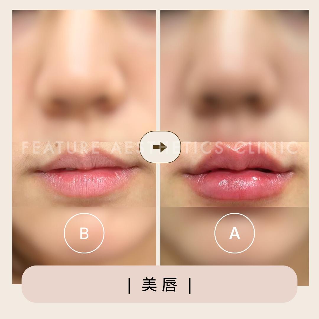 玻尿酸 - 馥之美診所美麗見證
