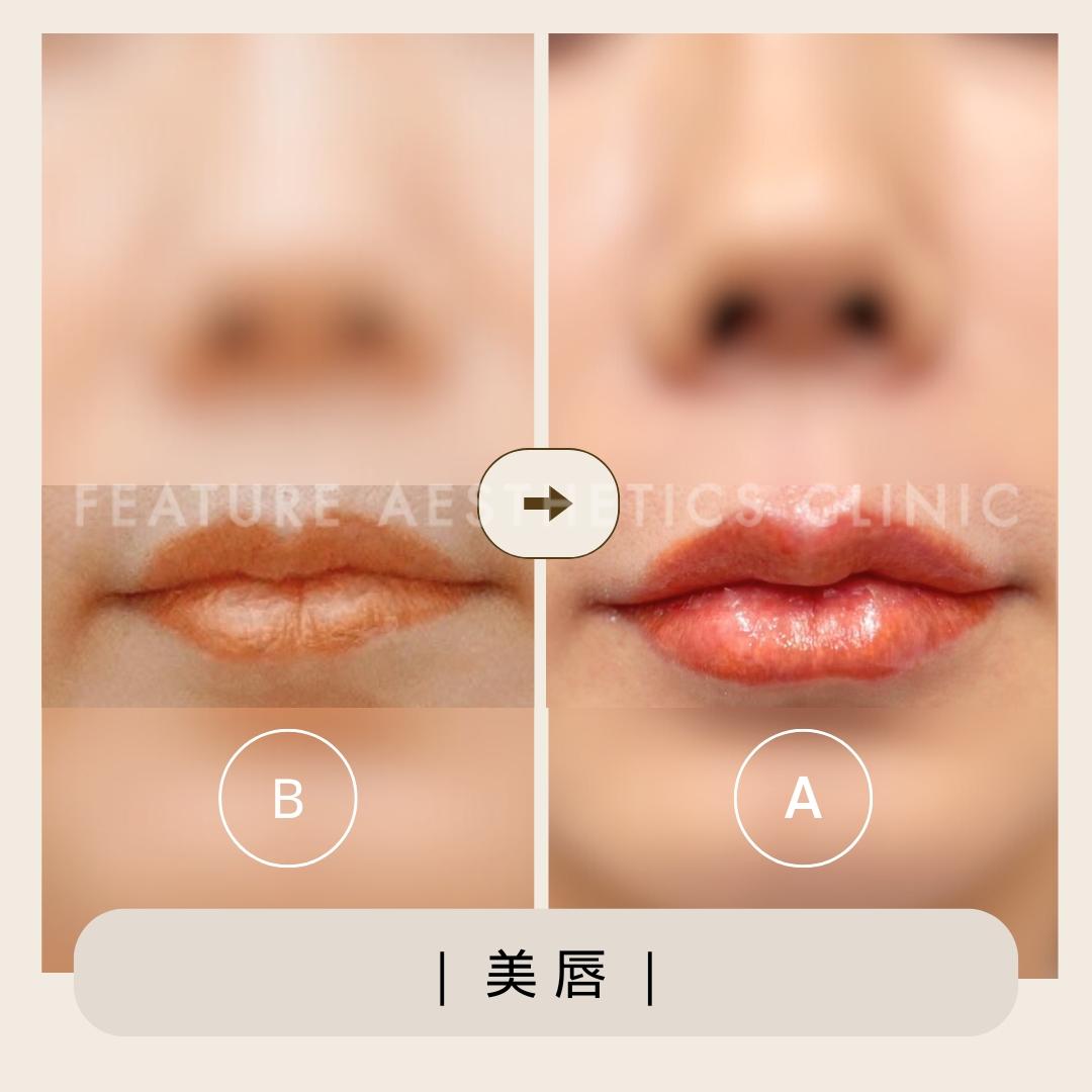 玻尿酸 - 馥之美診所美麗見證