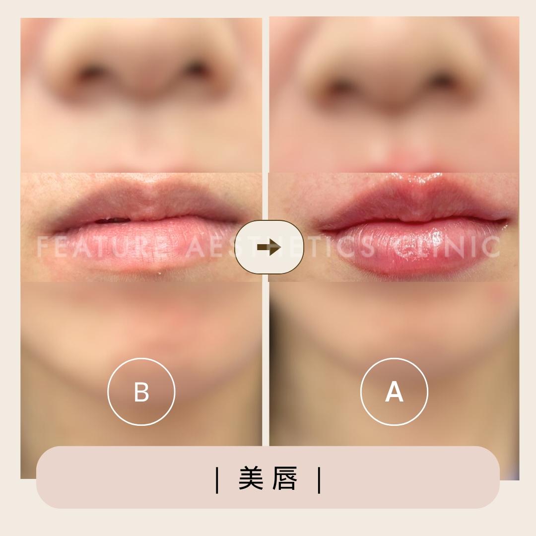 玻尿酸 - 馥之美診所美麗見證