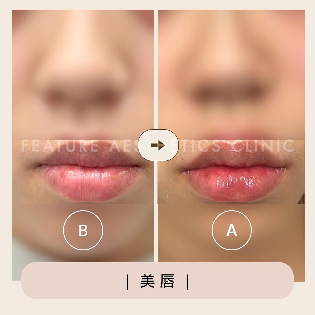 玻尿酸 - 馥之美診所美麗見證