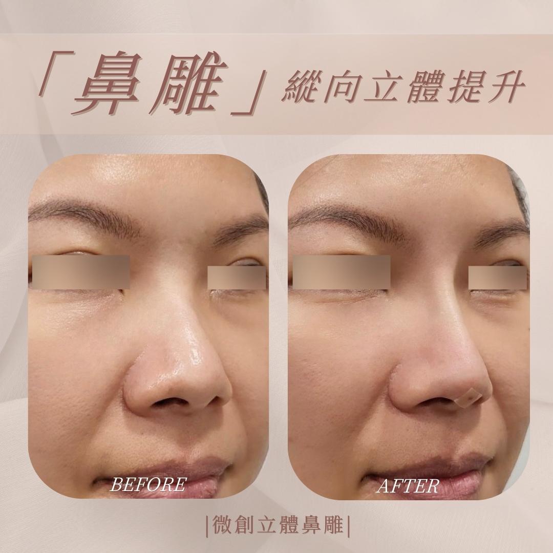 立體鼻線埋 - 馥之美診所美麗見證