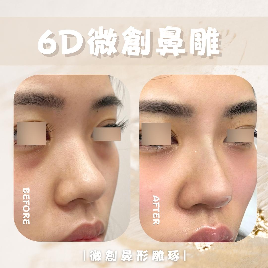 立體鼻線埋 - 馥之美診所美麗見證