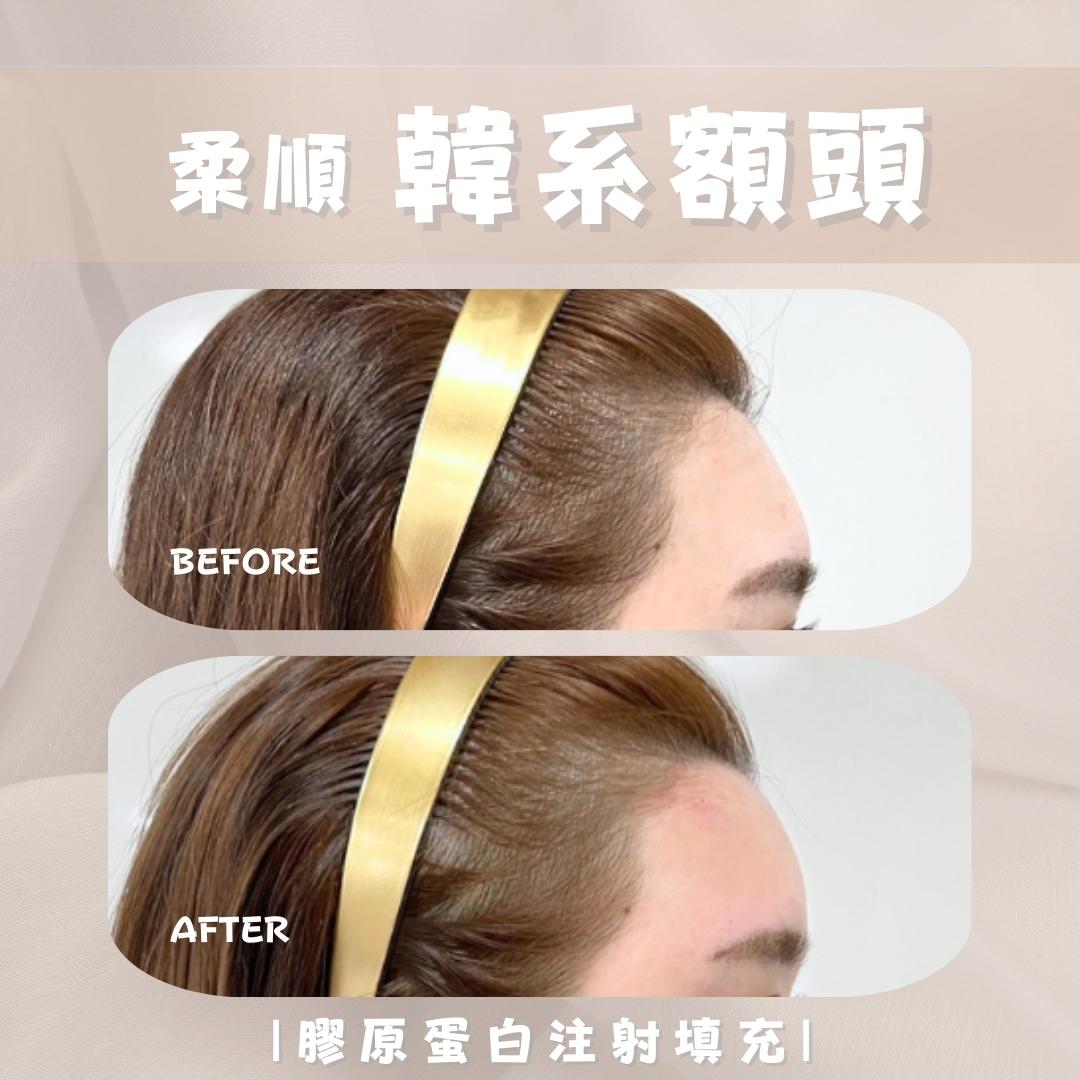 韓系額頭 - 馥之美診所美麗見證