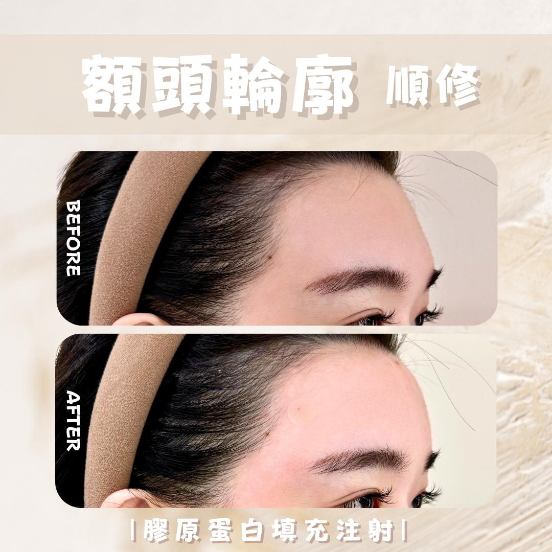 韓系額頭 - 馥之美診所美麗見證