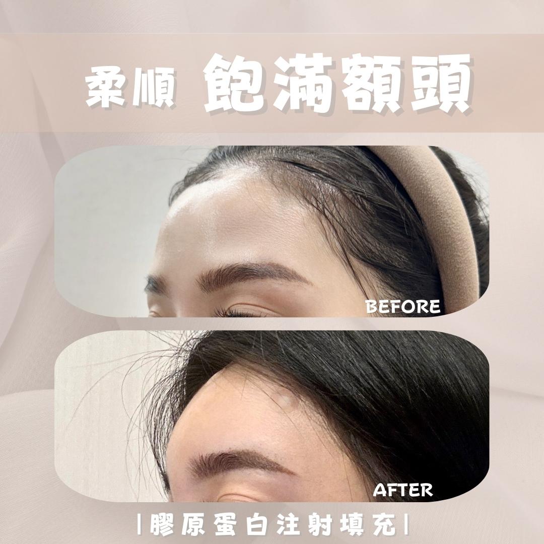 韓系額頭 - 馥之美診所美麗見證