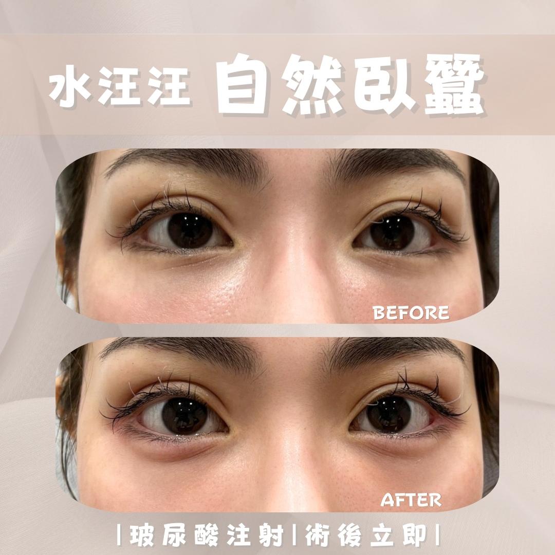 臥蠶 - 馥之美診所美麗見證
