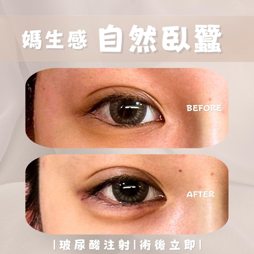 臥蠶 - 馥之美診所美麗見證