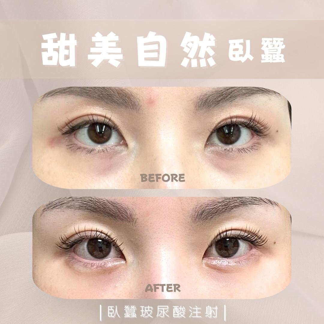 臥蠶 - 馥之美診所美麗見證