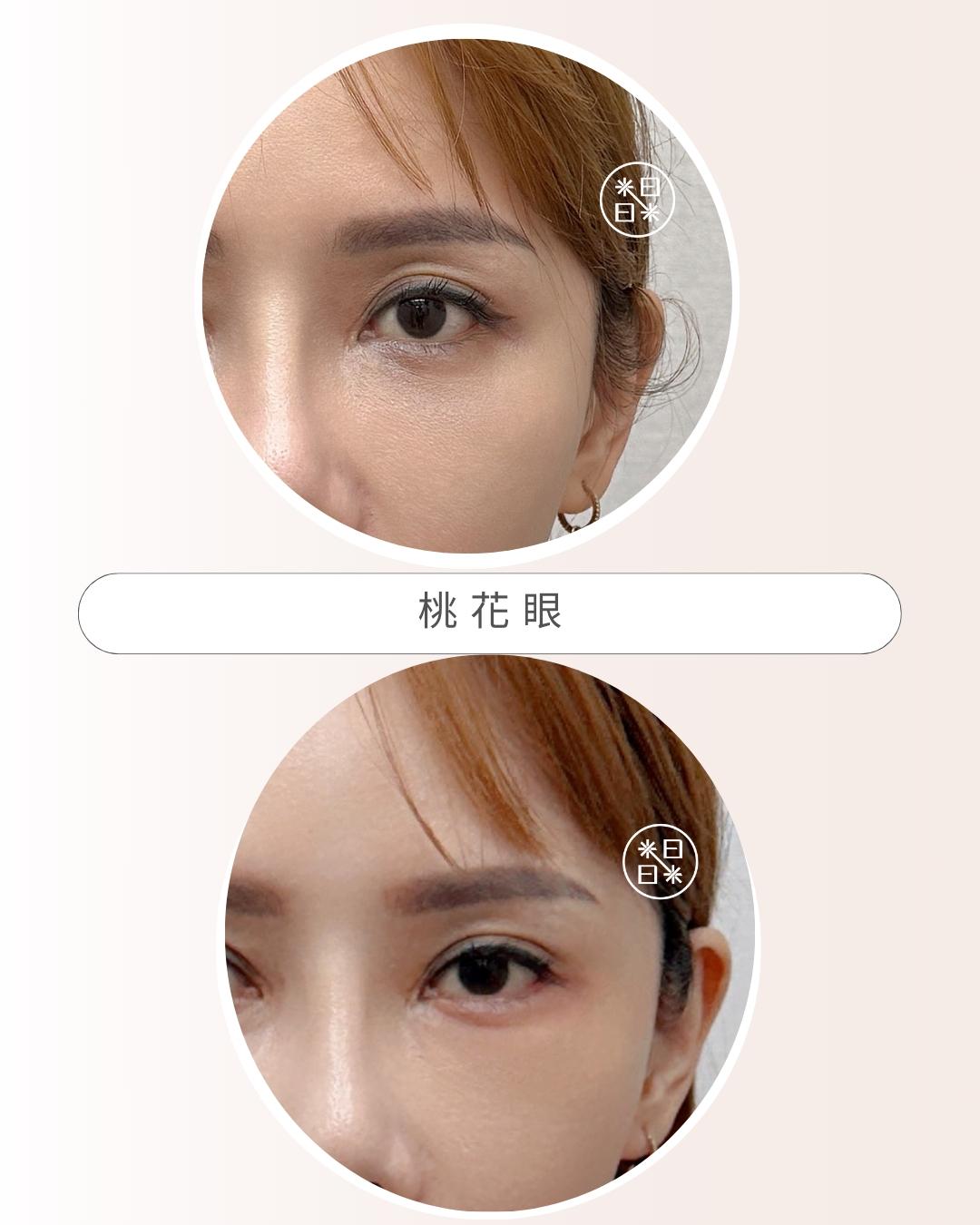 臥蠶 - 馥之美診所美麗見證