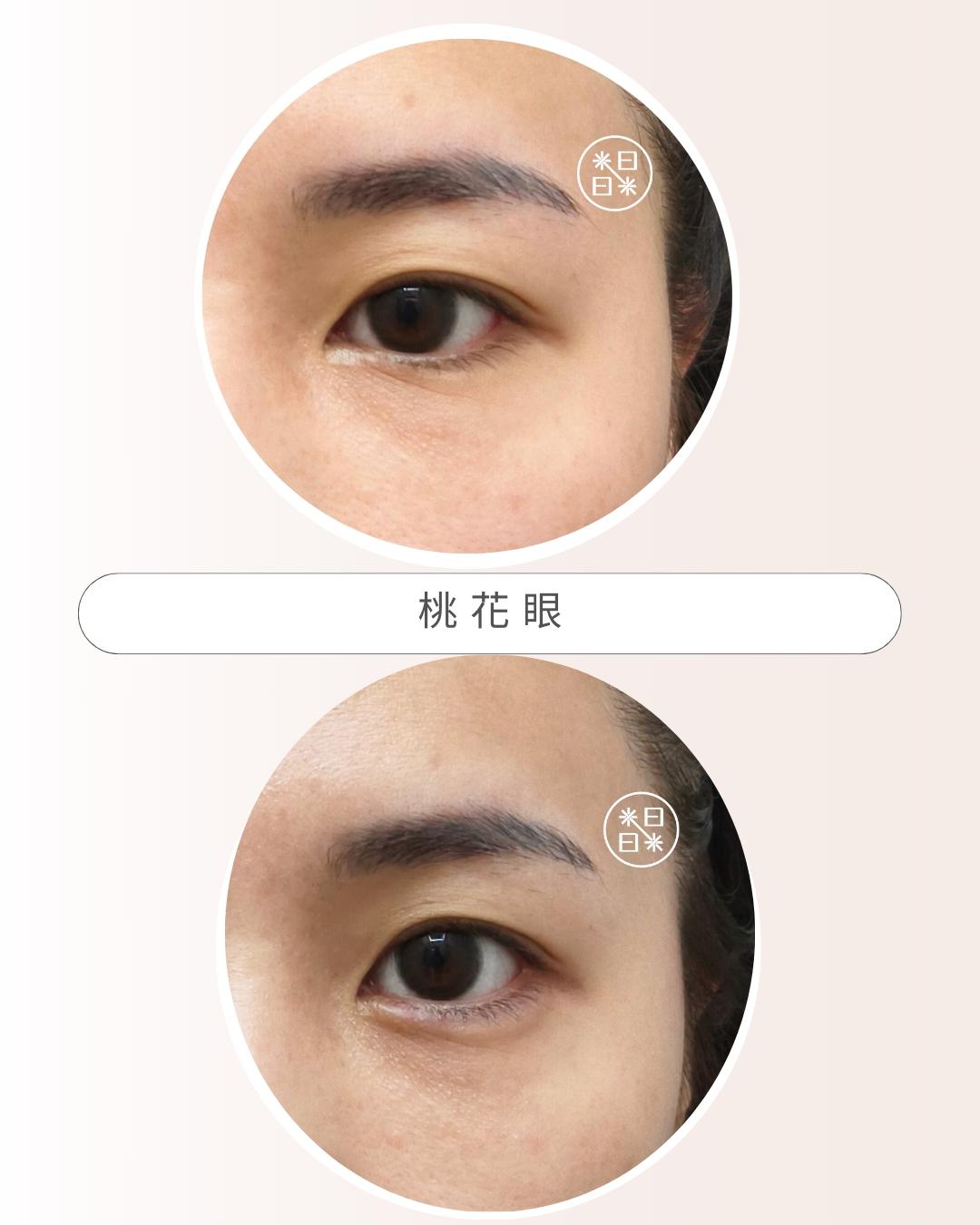 臥蠶 - 馥之美診所美麗見證
