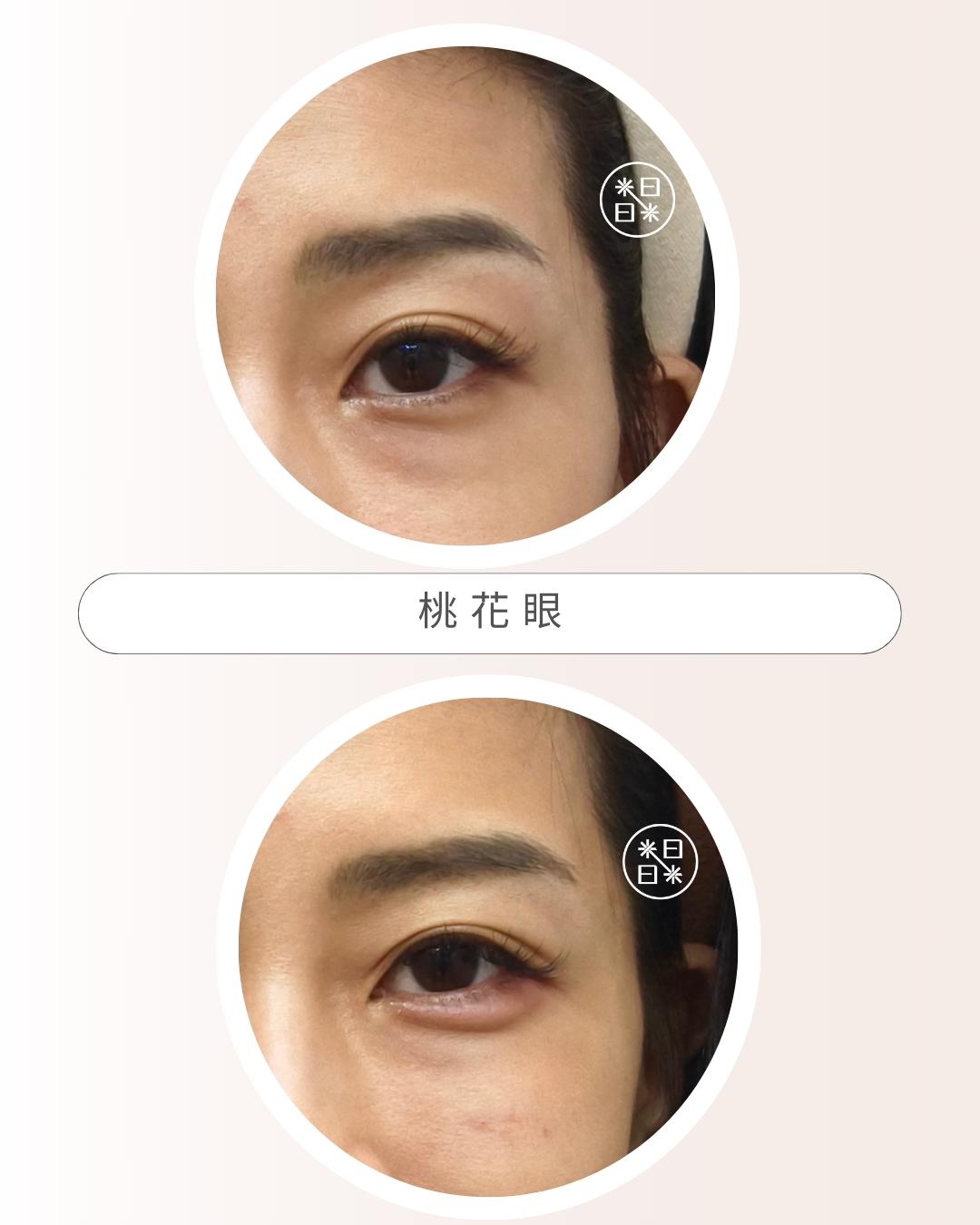 臥蠶 - 馥之美診所美麗見證