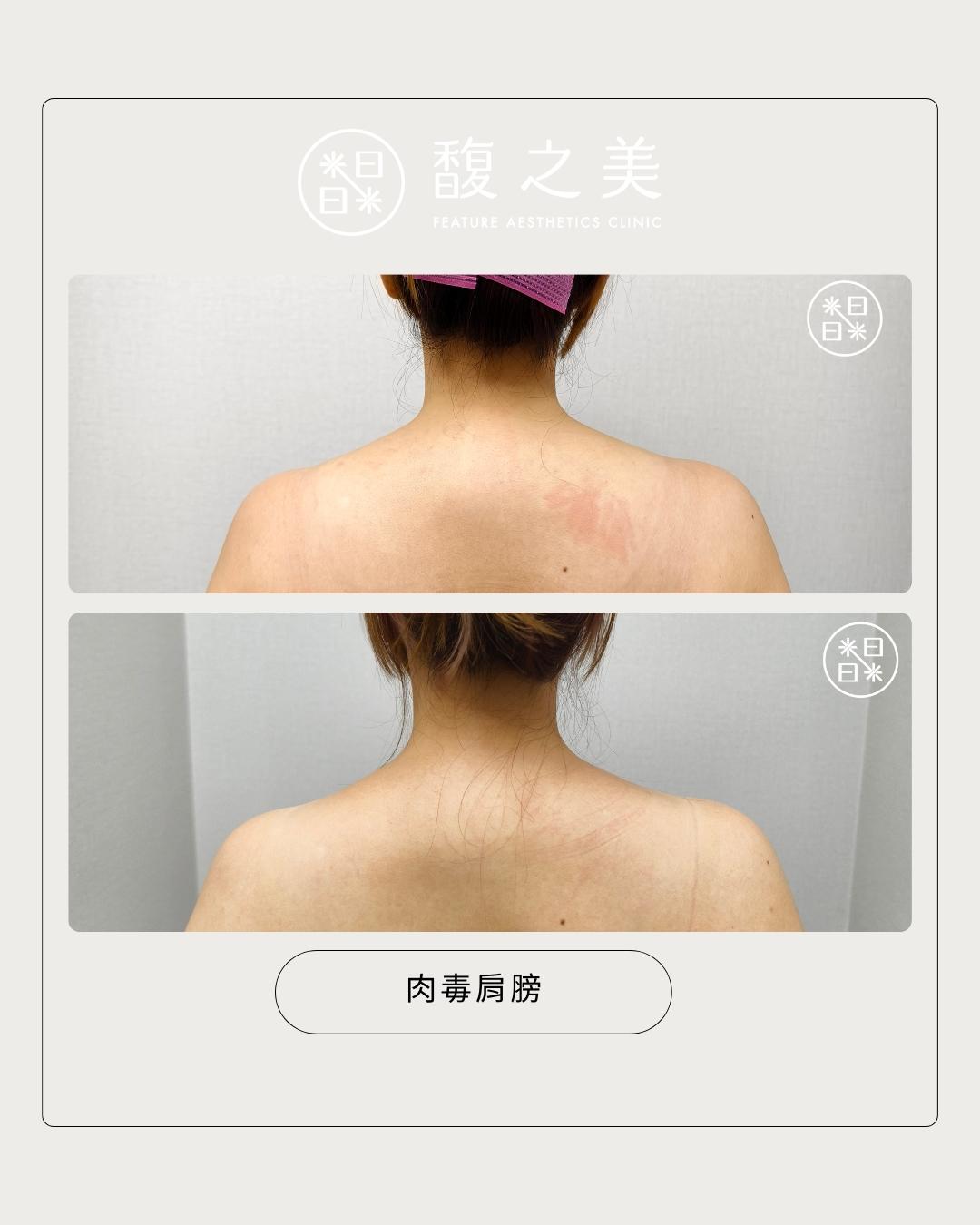 天鵝頸肩 - 馥之美診所美麗見證
