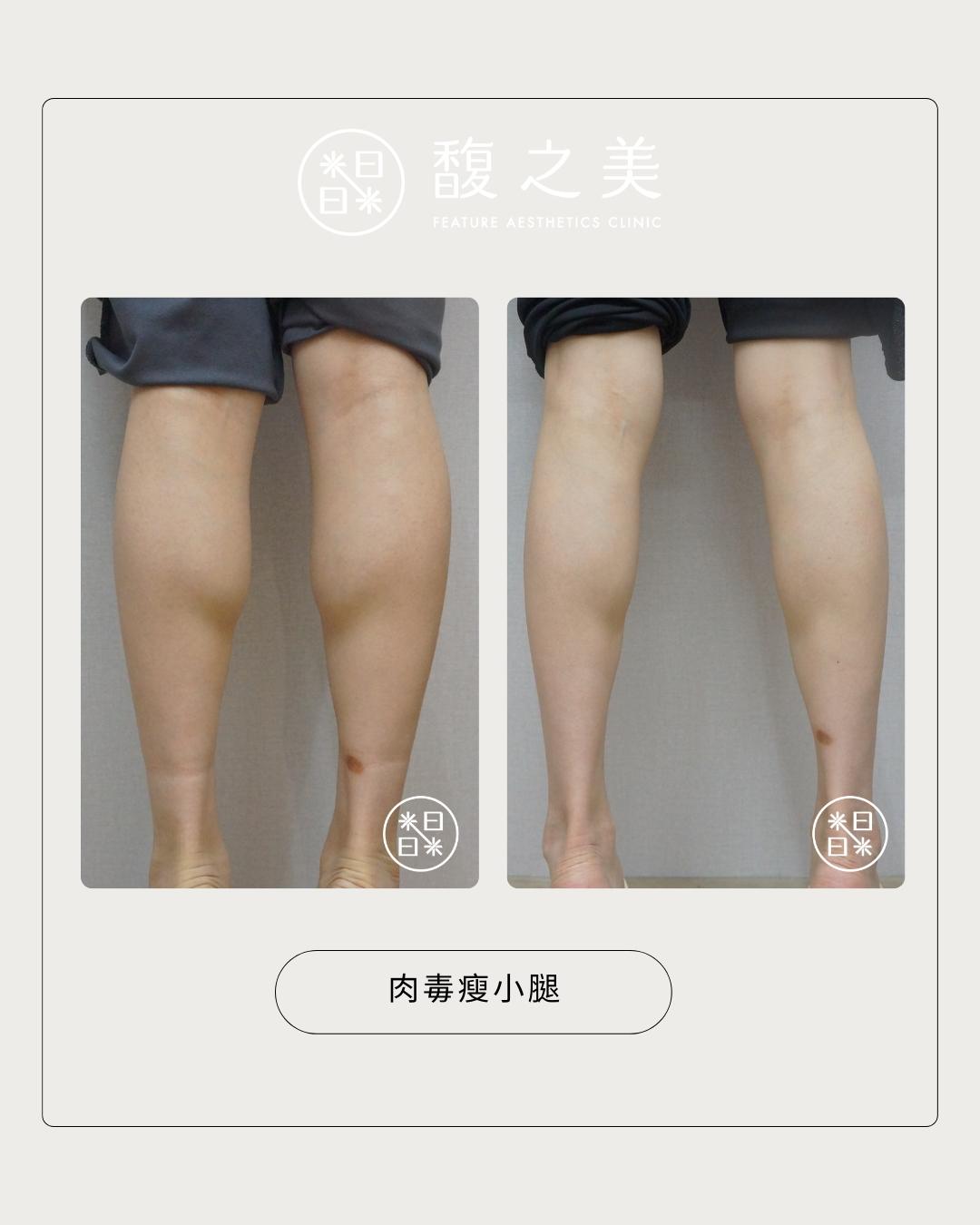 夏日纖腿 - 馥之美診所美麗見證