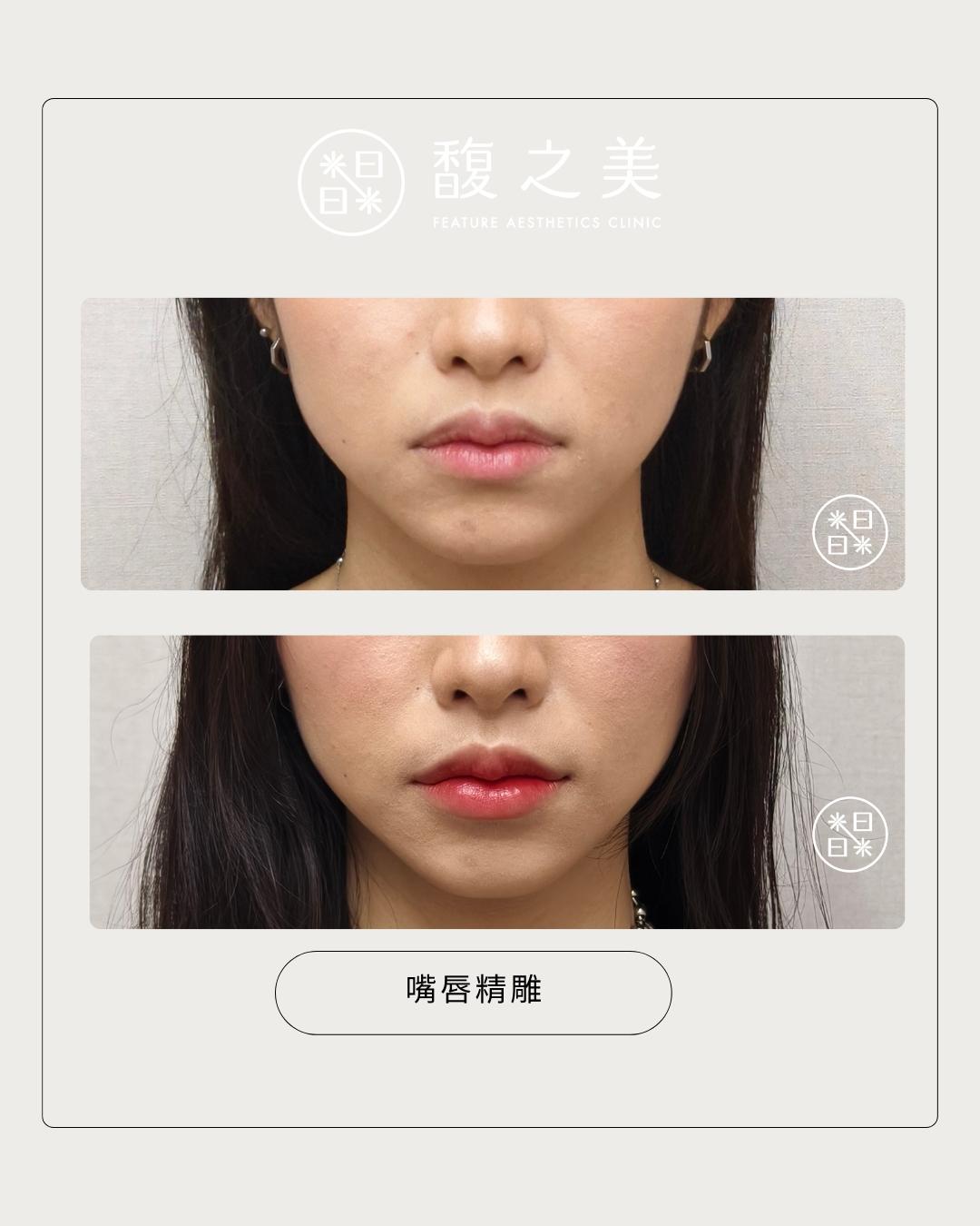 玻尿酸 - 馥之美診所美麗見證