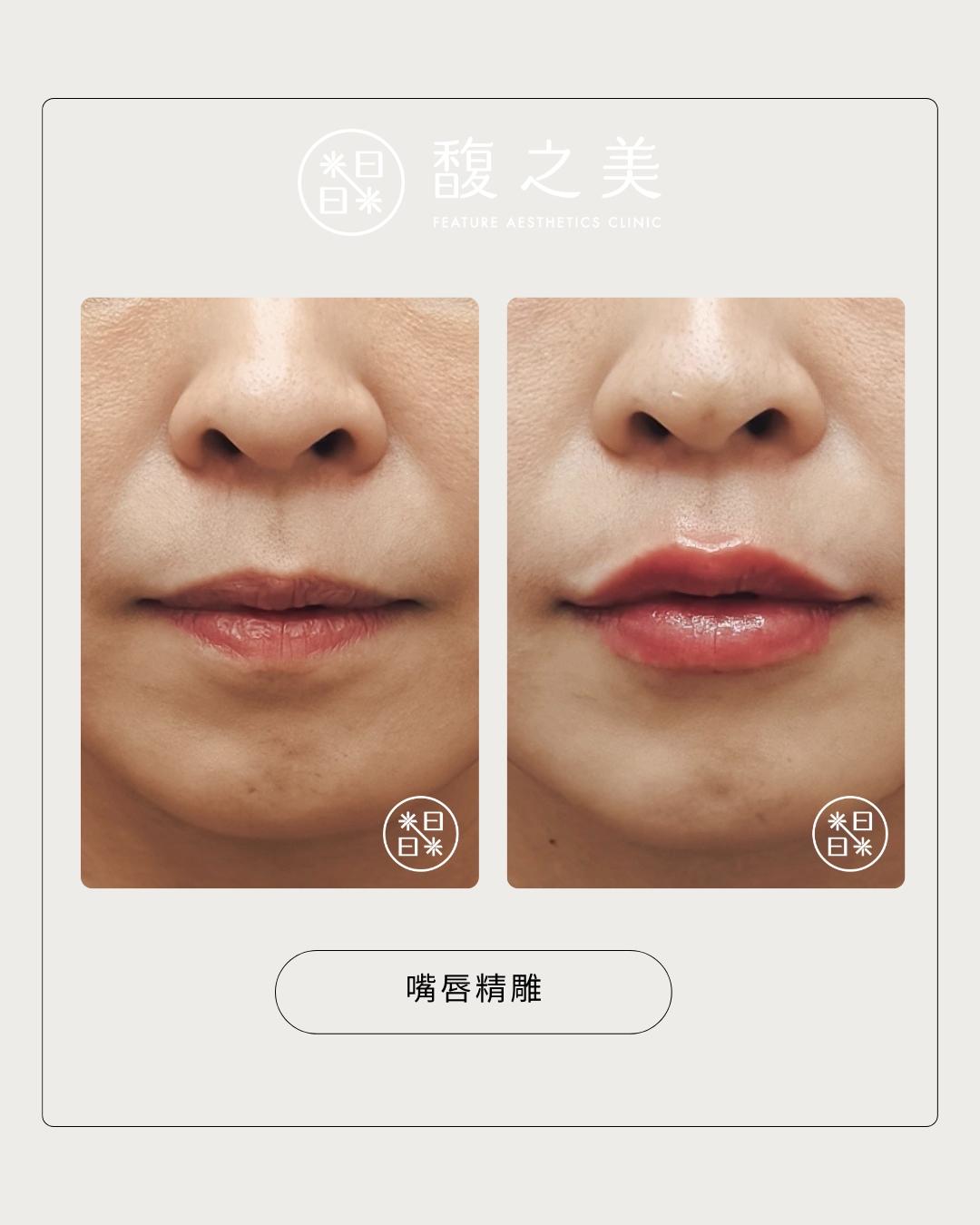 玻尿酸 - 馥之美診所美麗見證