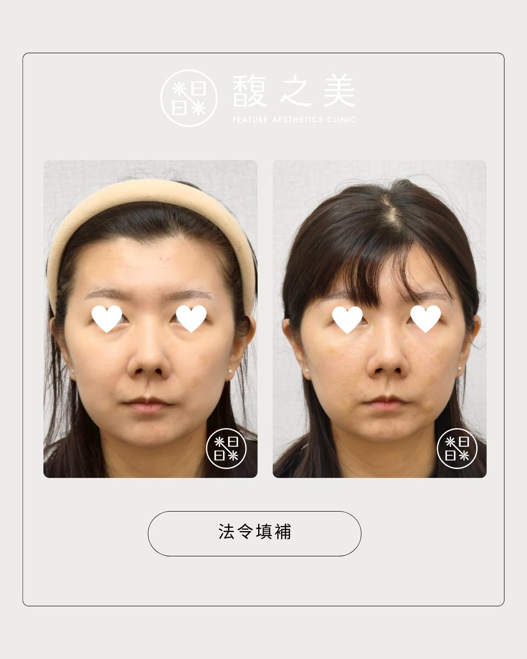 幼態提升術 - 馥之美診所美麗見證
