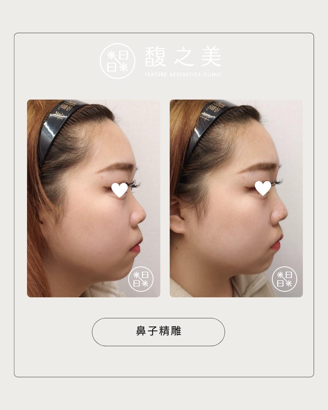 立體鼻線埋 - 馥之美診所美麗見證